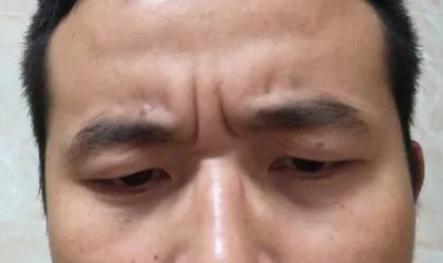 眉间川字纹 眉间川字纹