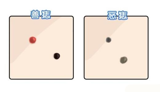 通过痣的形状来分辨 通过痣的形状来分辨